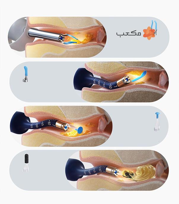 گوش پاک کن هوشمند Bebird 135R